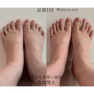 むくみ（足湯） ※若よもぎ蒸し協会　盗用禁止